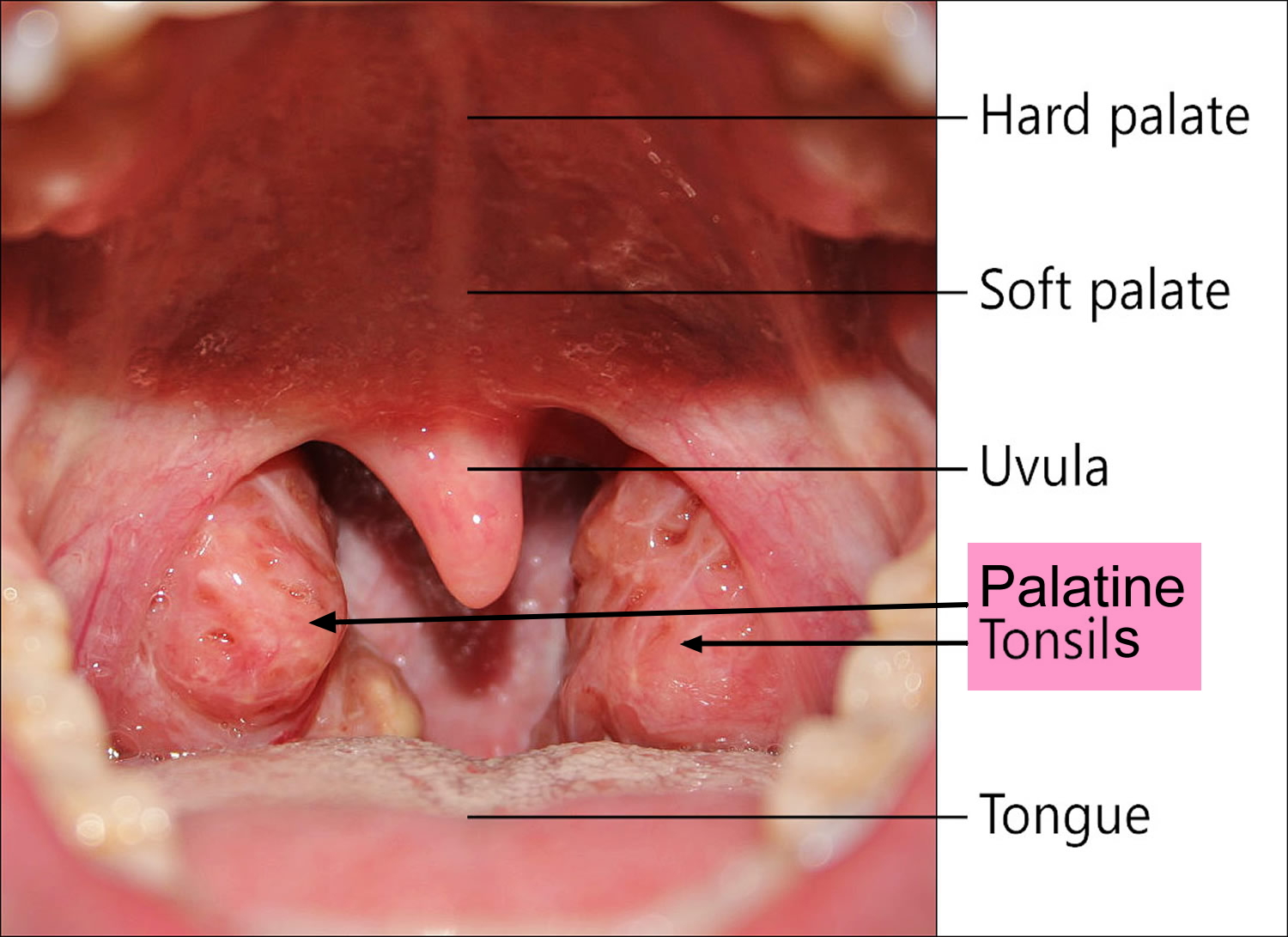 Peritonsillar Abscess Causes Signs Symptoms Diagnosis And Treatment