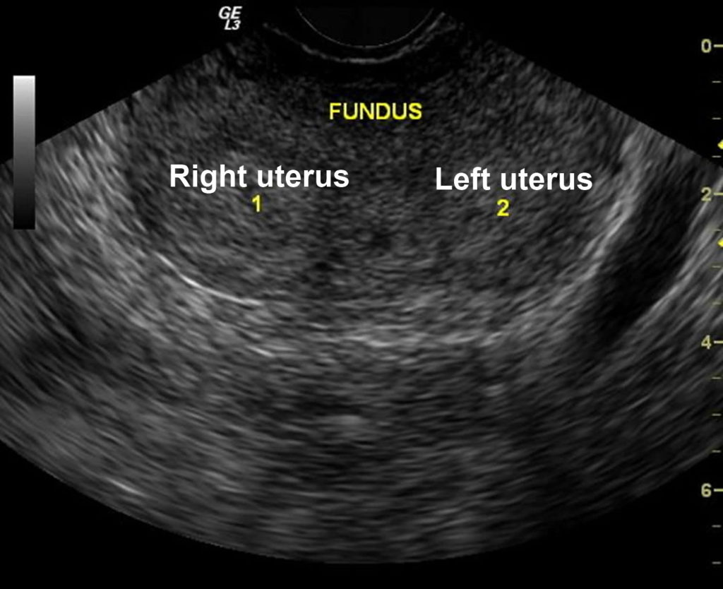 Bicornuate Uterus Causes Symptoms Ultrasound Fertility Pregnancy