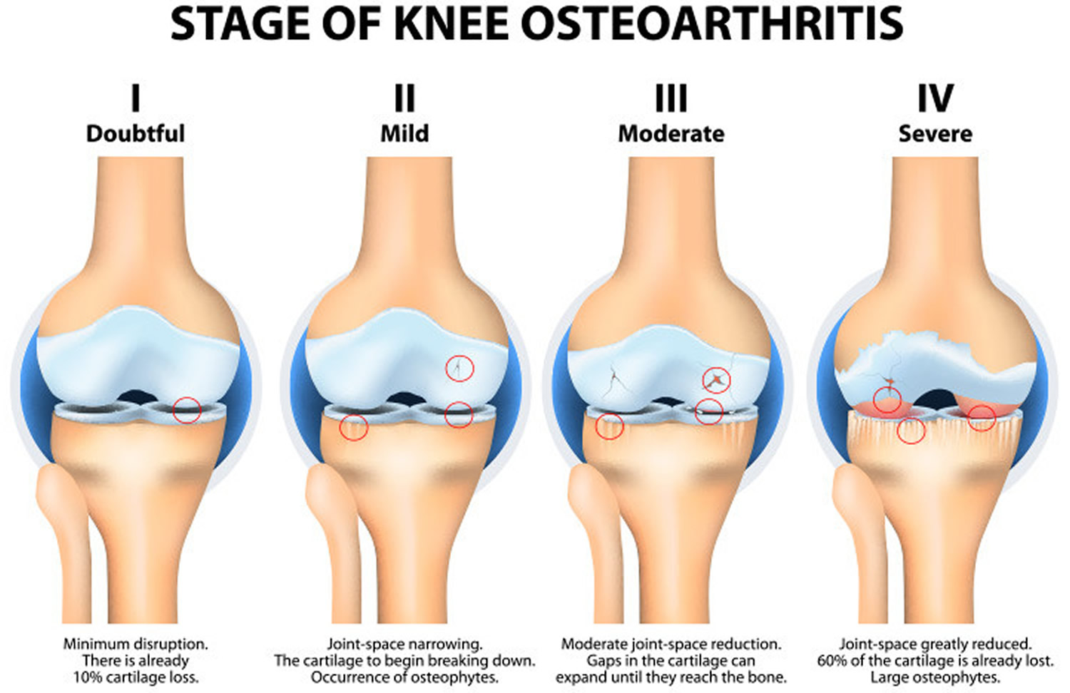 Osteoarthritis Causes Symptoms Diagnosis Prognosis Treatment