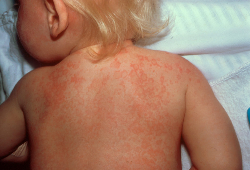 Kawasaki Disease Causes Signs Symptoms Treatment