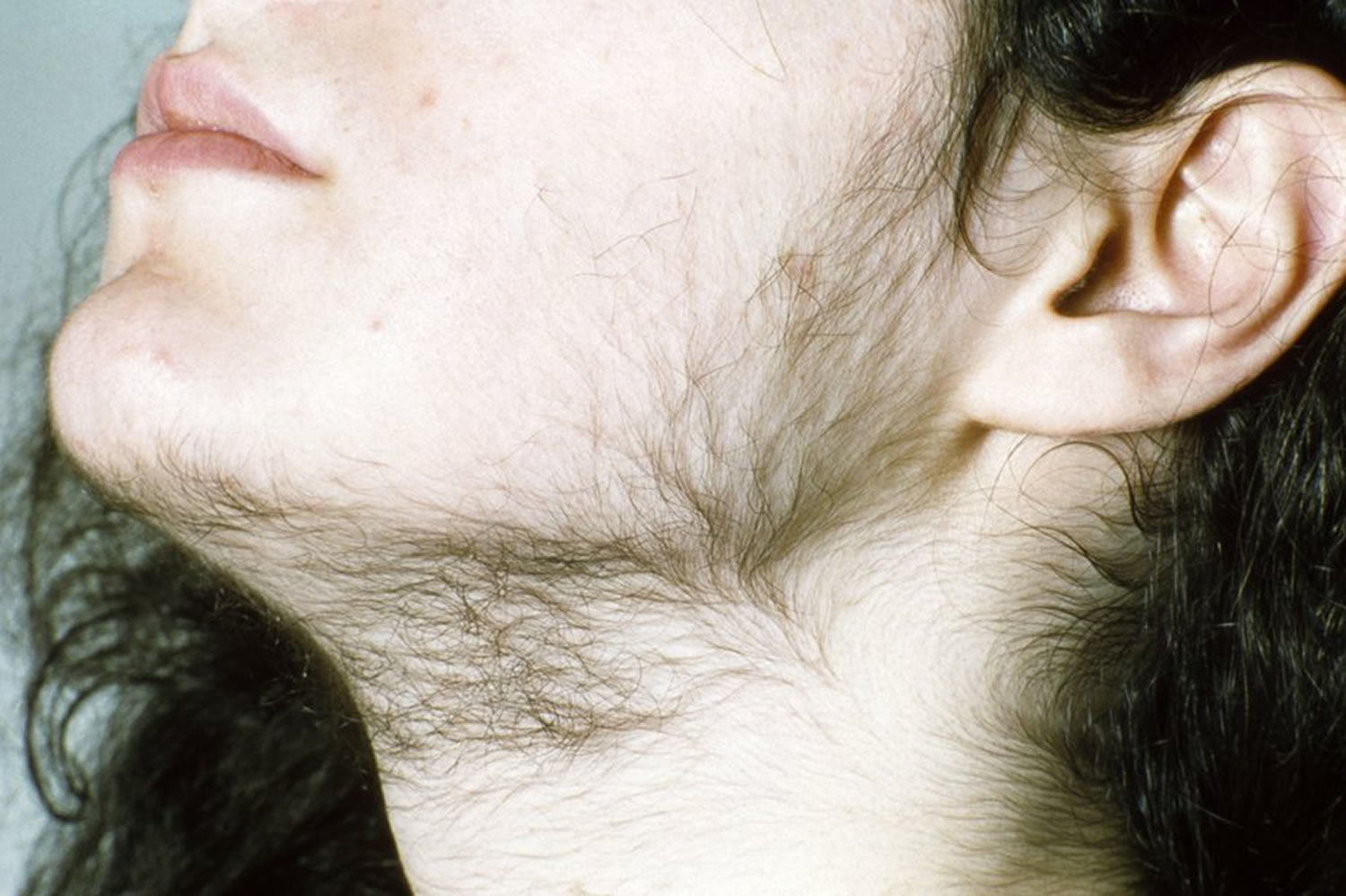 Facial hair on women steroids