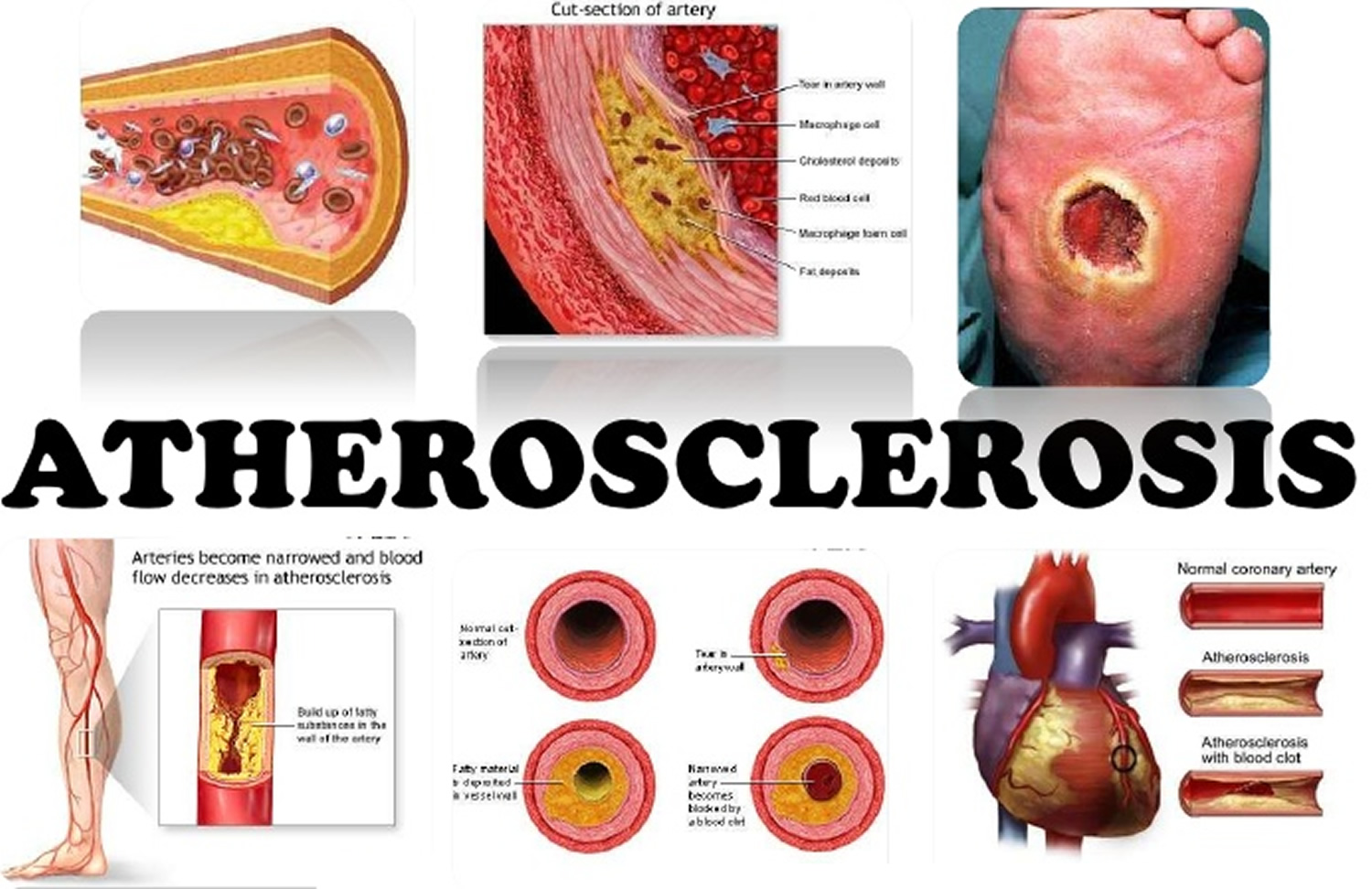 Atherosclerosis Causes Risk Factors Symptoms Diagnosis Treatment