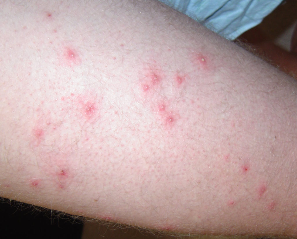 Folliculitis Causes Signs Symptoms How To Get Rid Of Folliculitis