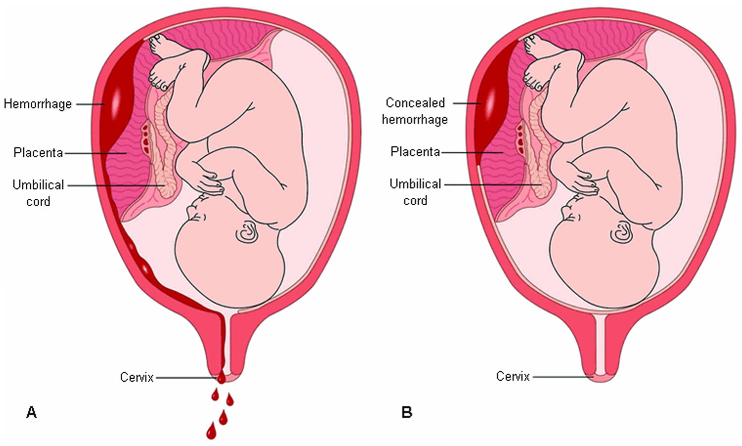 Anal leakage in third trimester