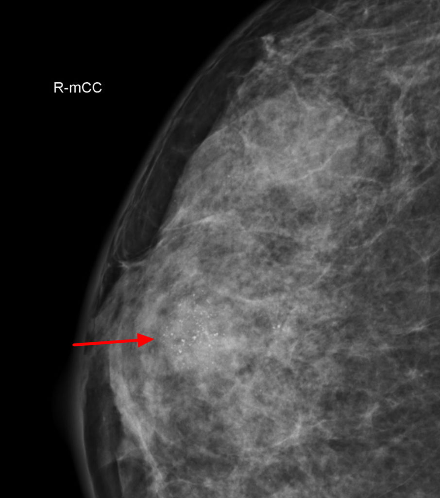 Fibroadenoma Causes Symptoms Diagnosis Treatment