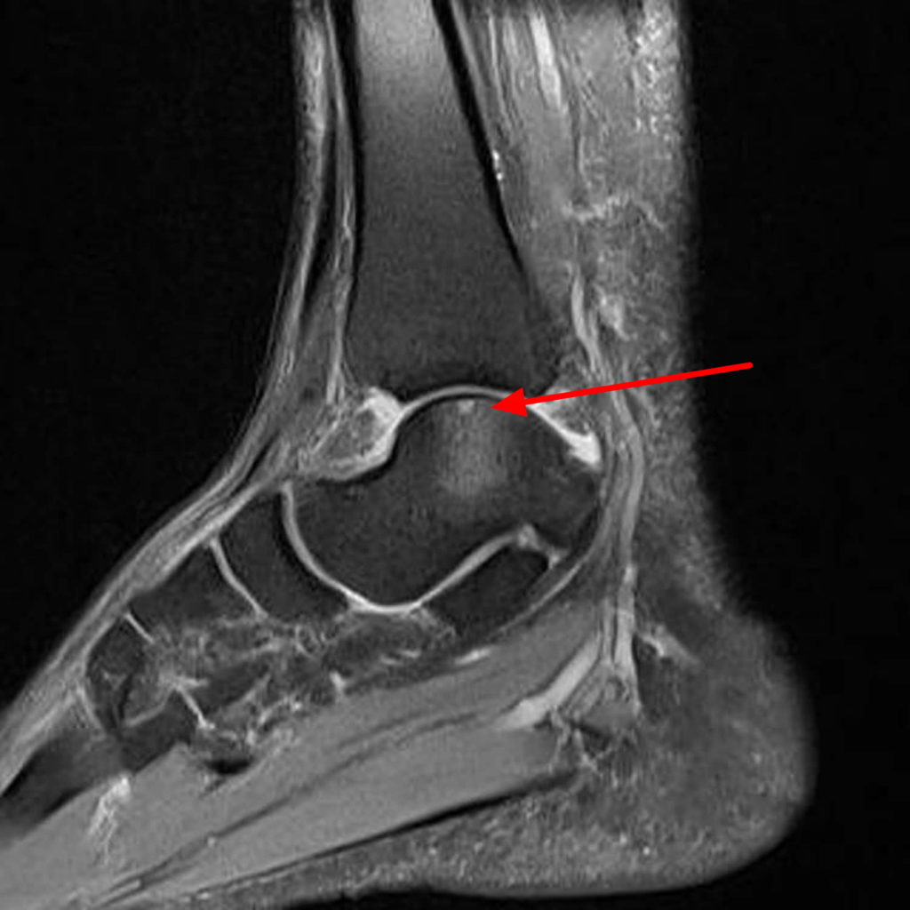 Osteochondritis Dissecans Causes Symptoms Diagnosis Treatment