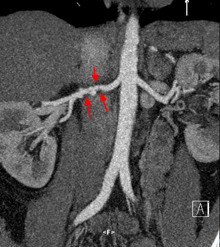 Fibromuscular Dysplasia Causes Symptoms Diagnosis Treatment