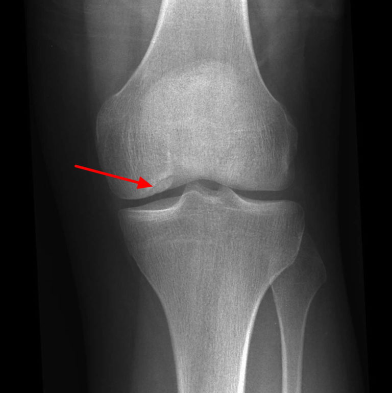 Osteochondritis Dissecans Causes Symptoms Diagnosis Treatment