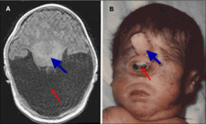 Holoprosencephaly Causes Diagnosis Prognosis And Treatment