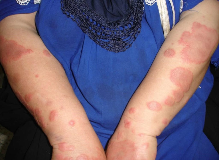 Erythema Multiforme Causes Types Symptoms Diagnosis And Treatment