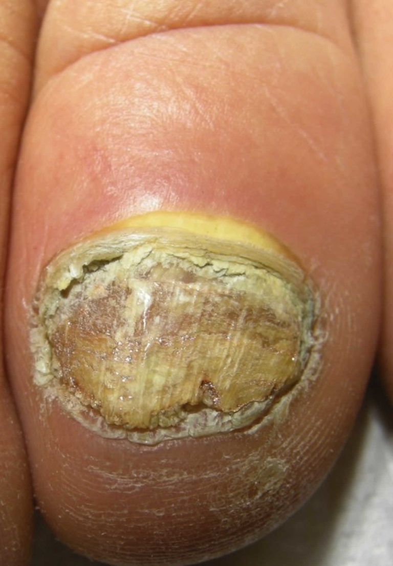 Onychomycosis Causes Clinical Appearance And Onychomycosis Treatment