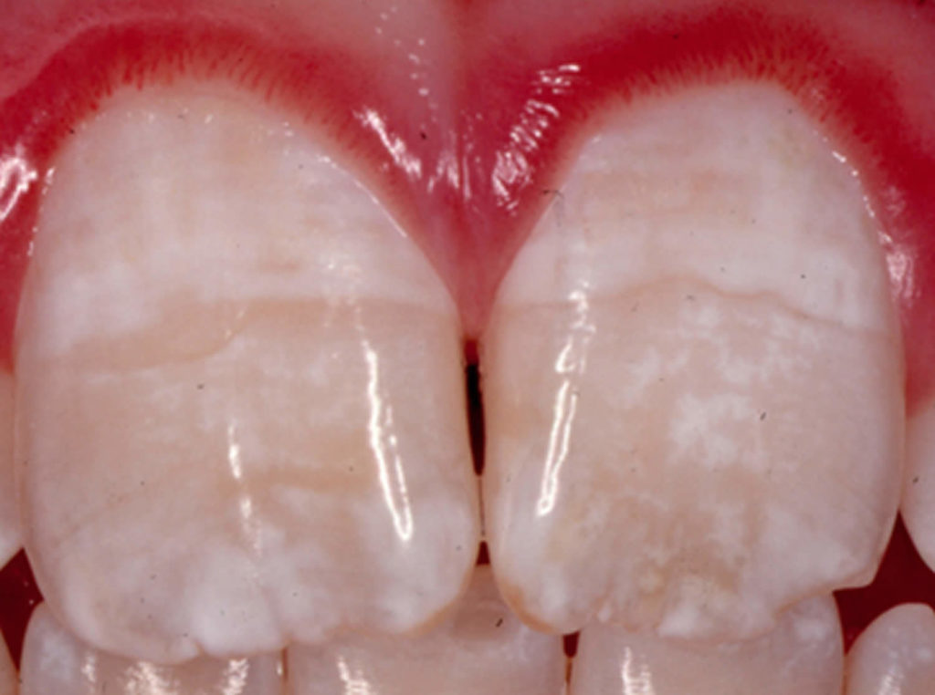 Dental Fluorosis Causes Prevention Symptoms Dental Fluorosis Treatment