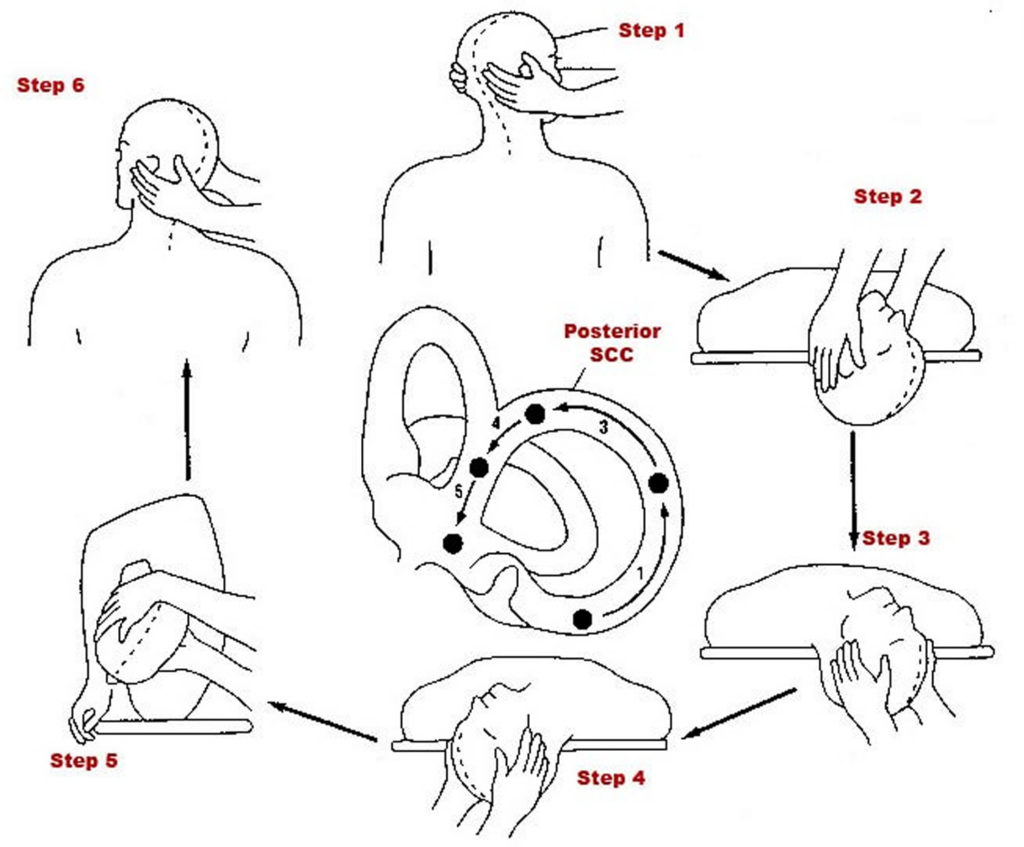 How To Safely Perform Epley Maneuver Home For Bppv Canalith Porn Sex