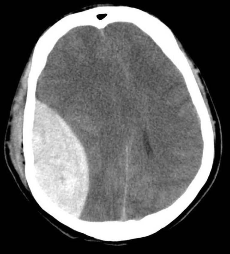 Brain Hemorrhage Causes Types Symptoms Diagnosis Treatment