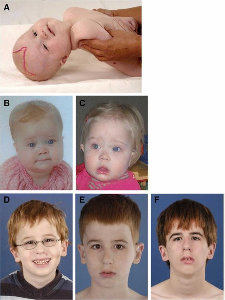 Zellweger Syndrome Causes Symptoms Diagnosis Treatment Life Expectancy