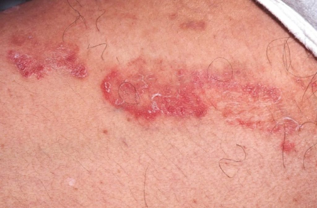 Tinea Cruris Definition Causes Symptoms Over The Counter Treatment