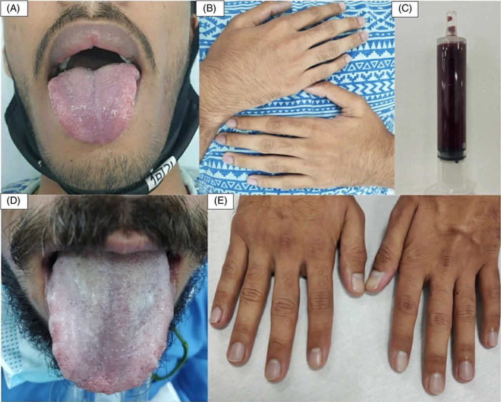 Cyanosis Definition Causes Symptoms Diagnosis Treatment