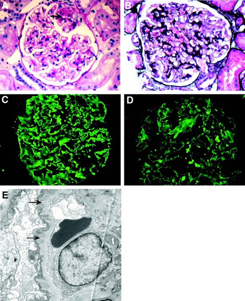 Membranous Nephropathy Causes Symptoms Diagnosis Treatment Prognosis