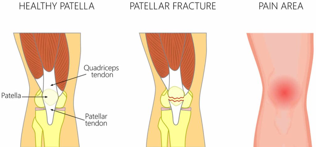 Patella Fracture Causes Types Symptoms Diagnosis Treatment Recovery