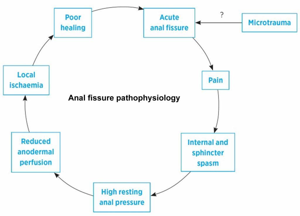 Anal Fissure Causes Signs Symptoms Diagnosis Treatment