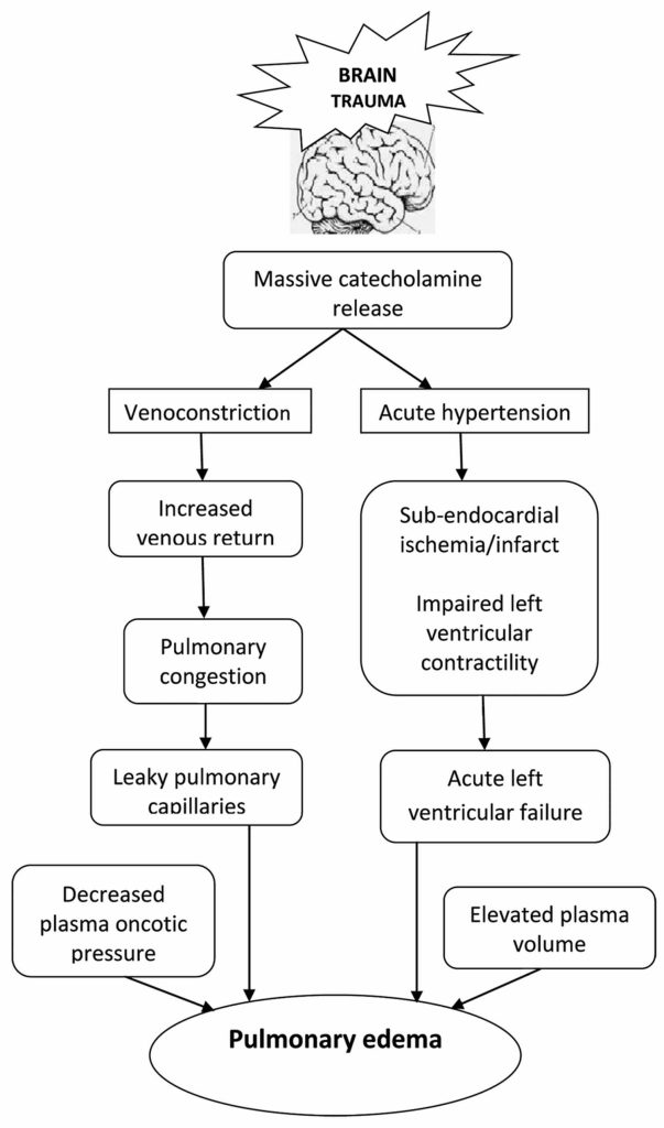 Neurogenic Pulmonary Edema Causes Symptoms Diagnosis Treatment