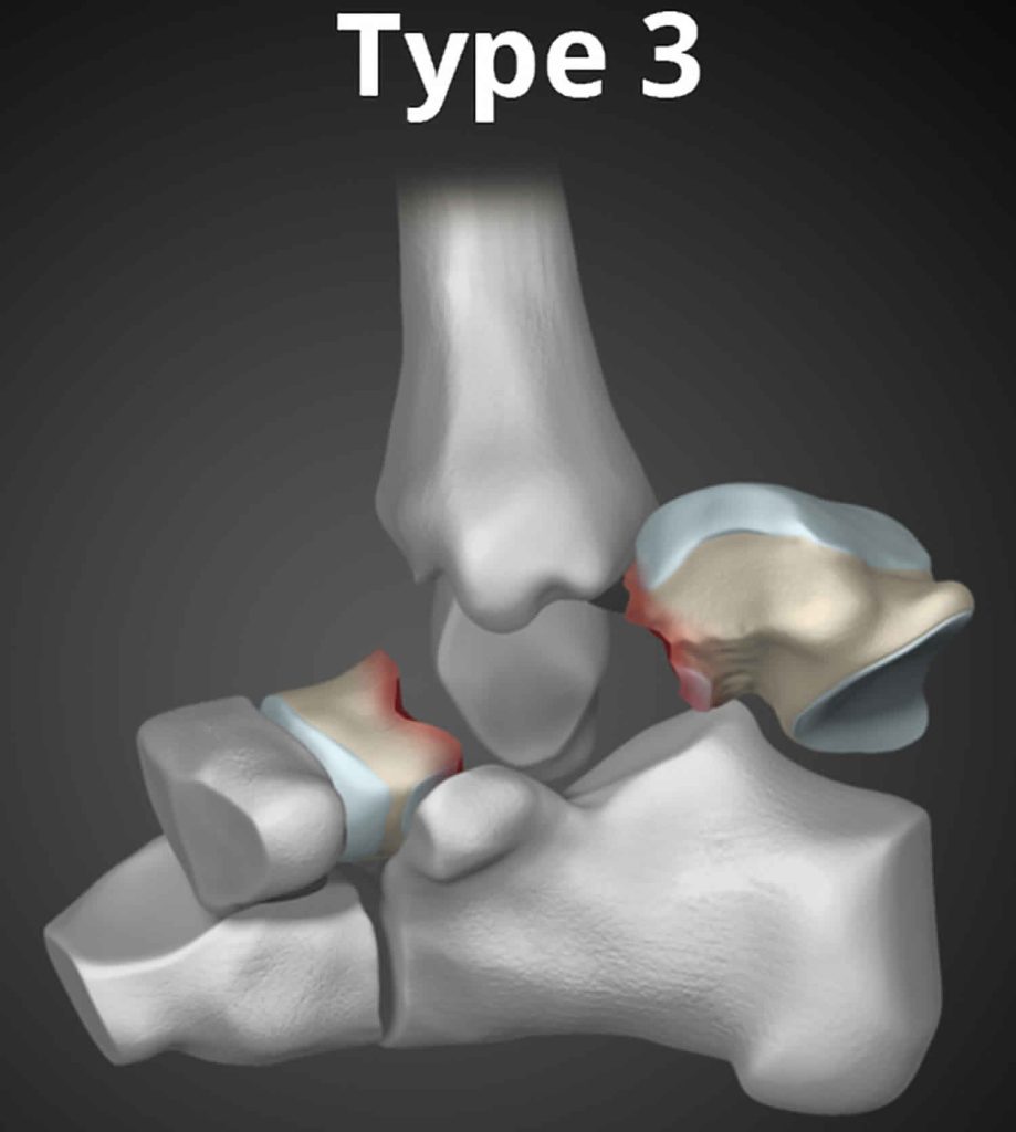 Talus Fracture Causes Types Symptoms Complications Diagnosis