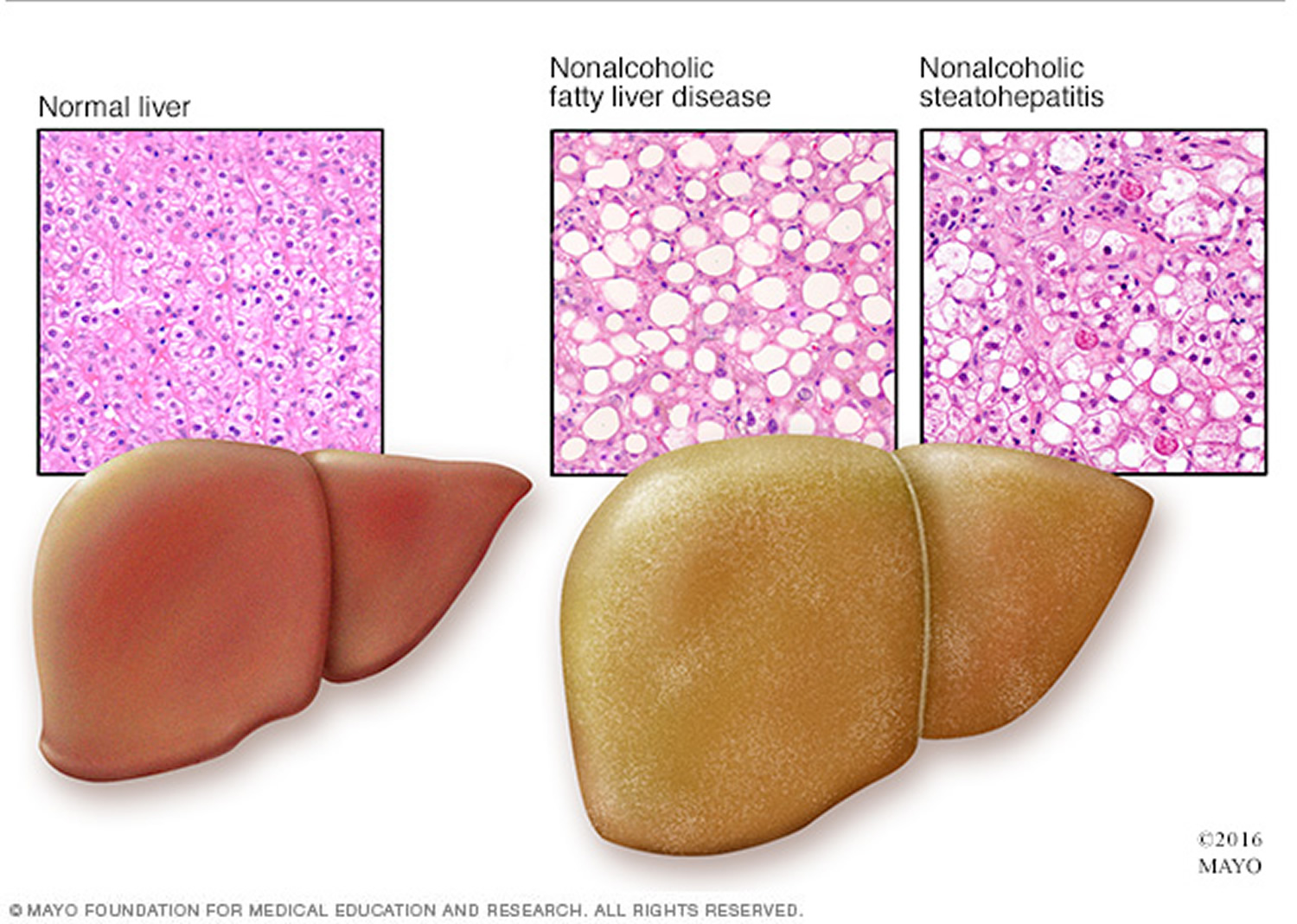 fatty-liver-treatments-how-to-cure-fatty-liver-naturally-youtube