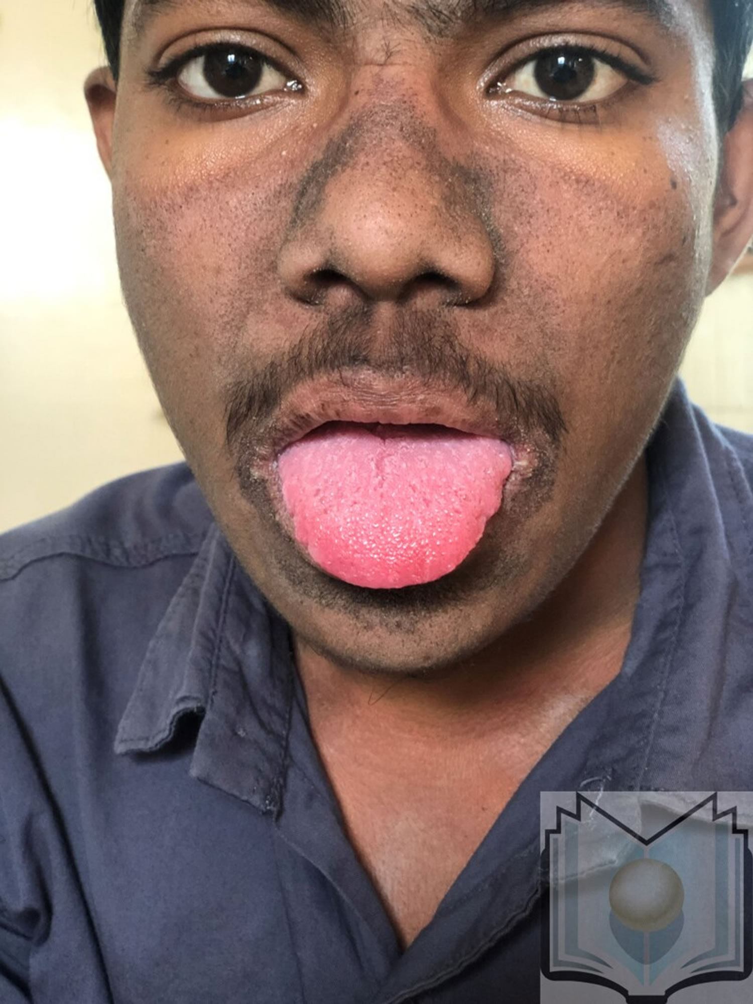 Niacin deficiency tongue