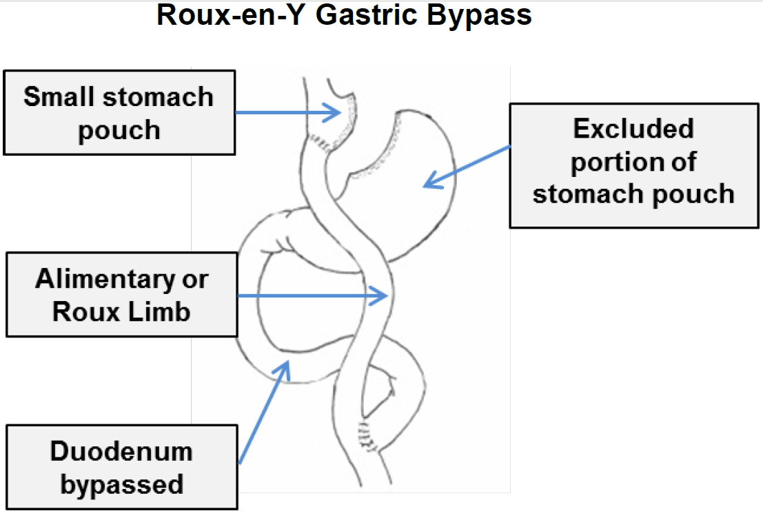 roux-en-y gastric bypass surgery