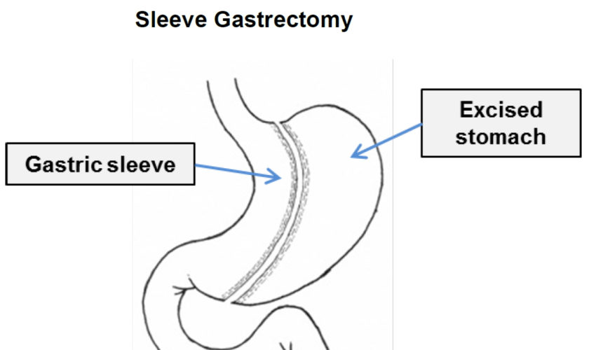 sleeve gastrectomy bariatric surgery