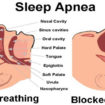 Sleep-Apnea-Causes