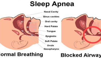 Sleep-Apnea-Causes