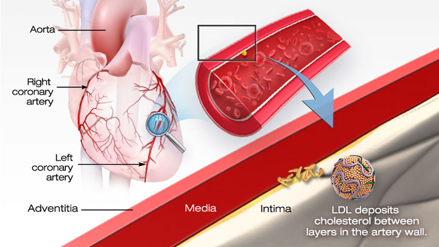 cholesterol-and-coronary-artery-disease