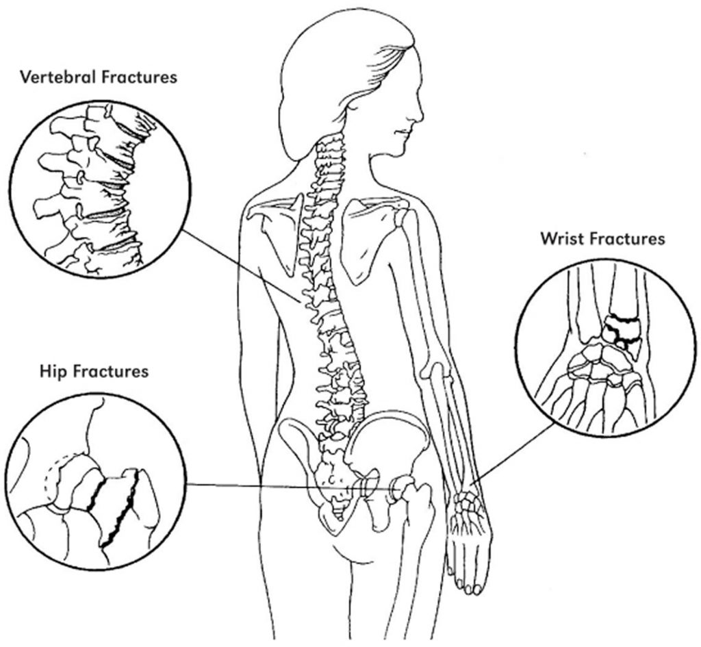 Osteoporosis - Causes, Risk Factors & Treatment, Symptoms, Medications