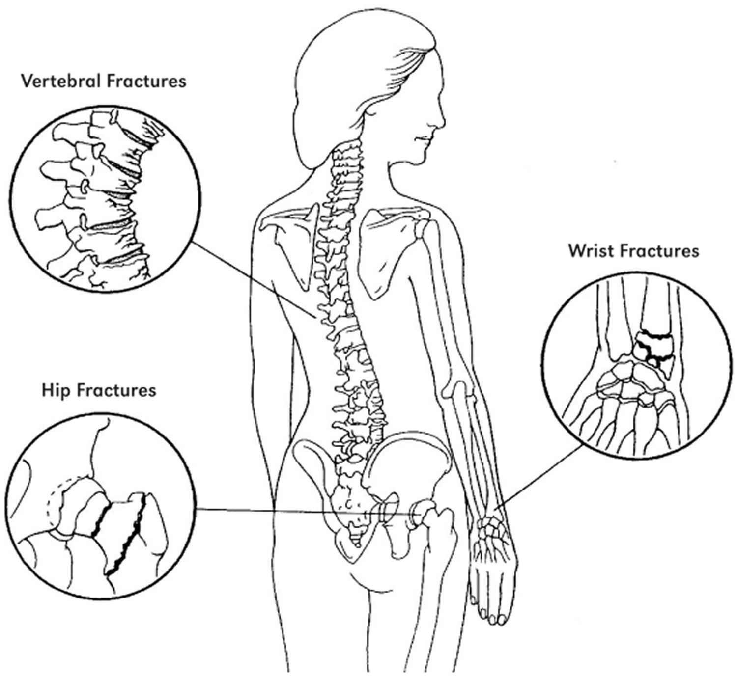 osteoporosis without current pathological fracture