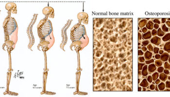 osteoporosis