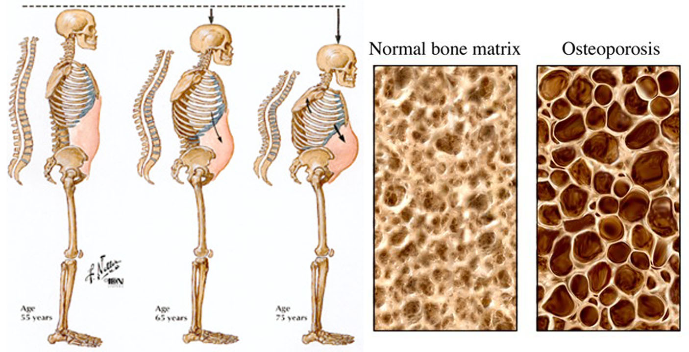 Osteoporosis - Causes, Risk Factors & Treatment, Symptoms, Medications