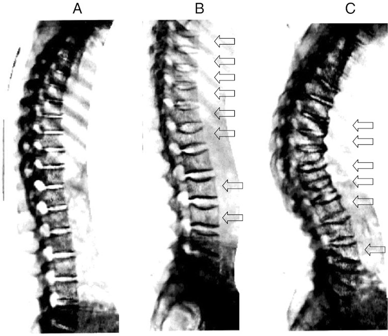spine x-rays of severe compression fractures