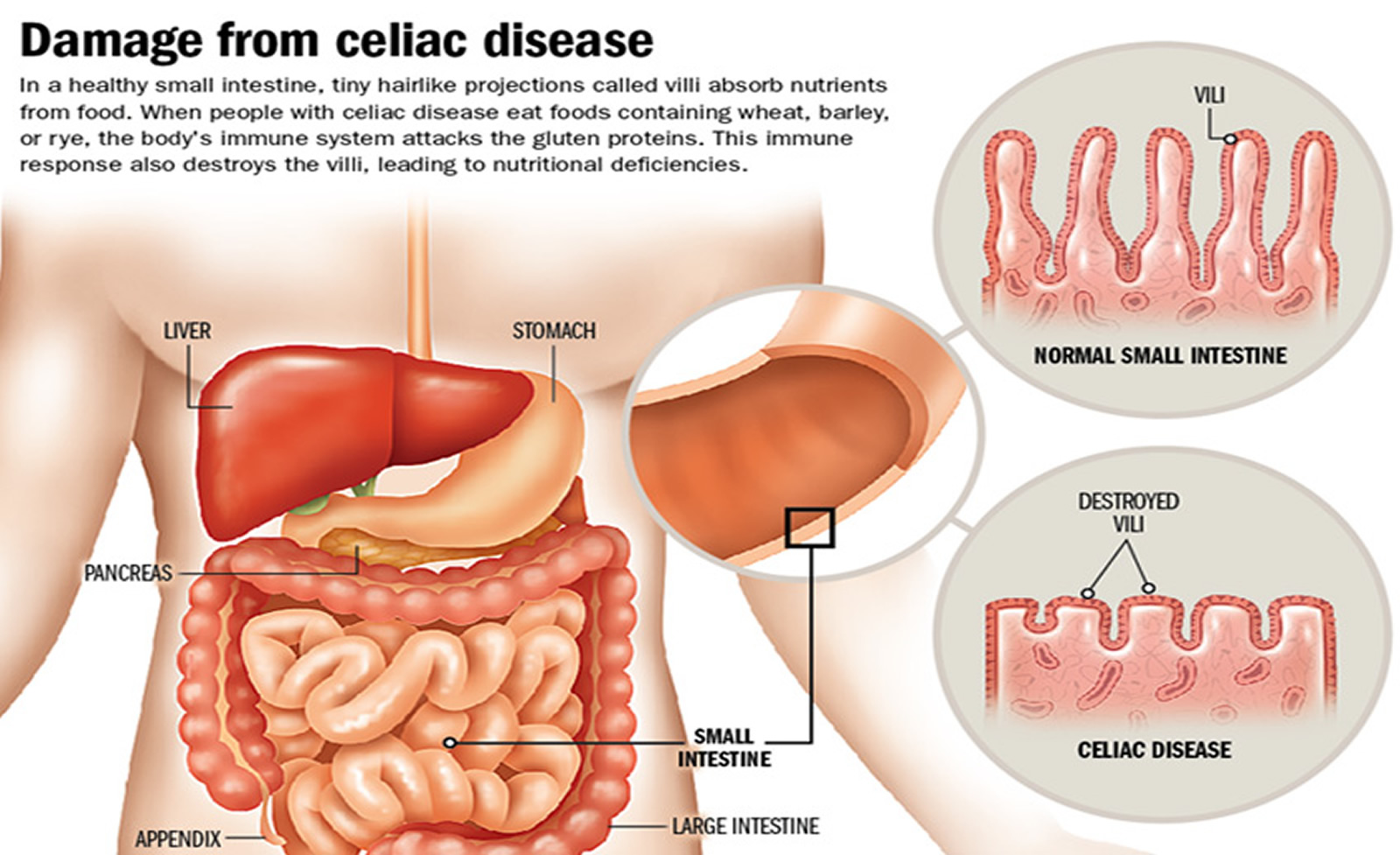 Is Celiac Disease A Death Sentence