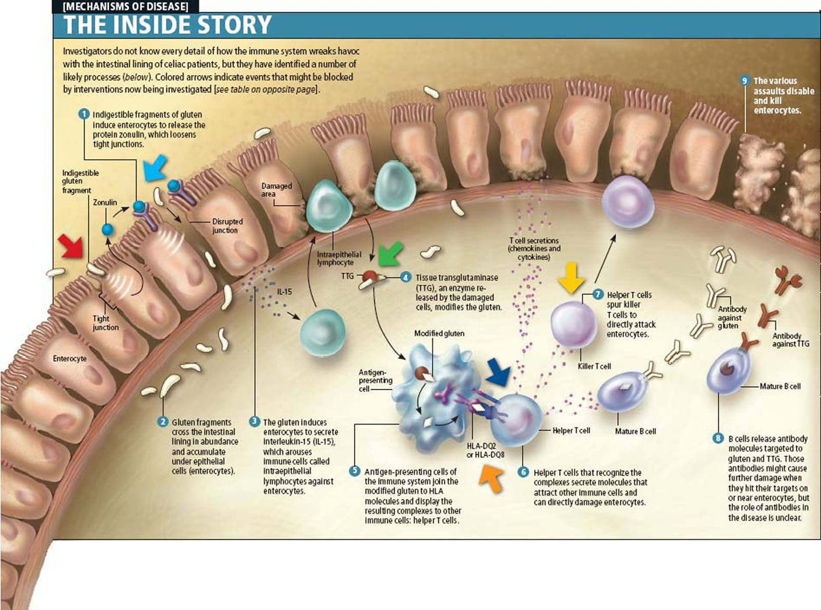 Celiac Disease - Diagnosis, Symptoms, Treatment, Diet &amp; Foods to Avoid