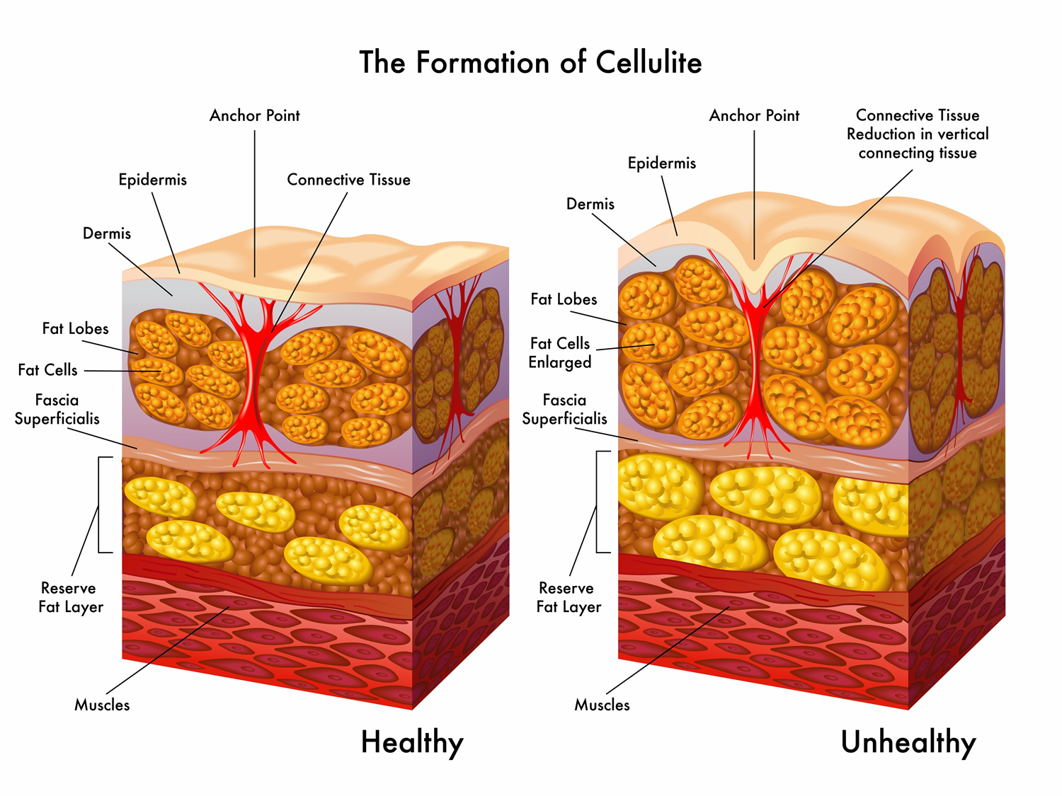 What is Cellulite? How to Get Rid of Cellulite Fast - Include Home Remedy