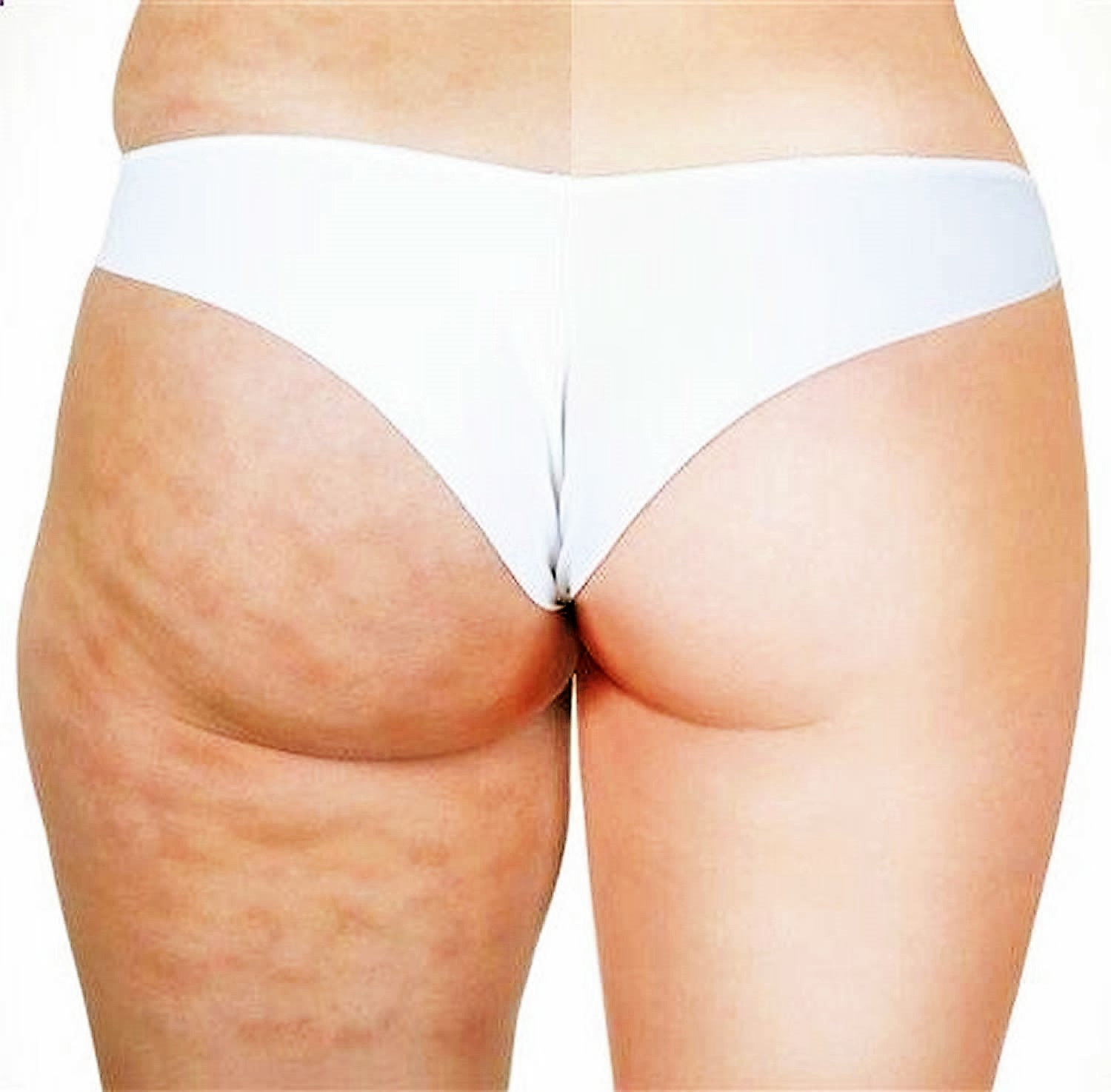 Treating Cellulite - East Bay Plastic Surgery In Oakland, Ca Can Be Fun For Everyone thumbnail