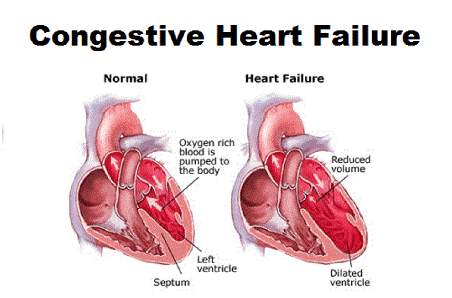 what-is-congestive-heart-failure-stages-causes-signs-symptoms