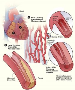 Signs & Symptoms of a Heart Attack. What You Should Do To Save Life