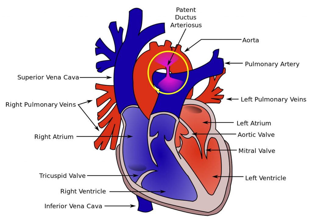 What is Congenital Heart Disease - Types, Causes, and Symptoms