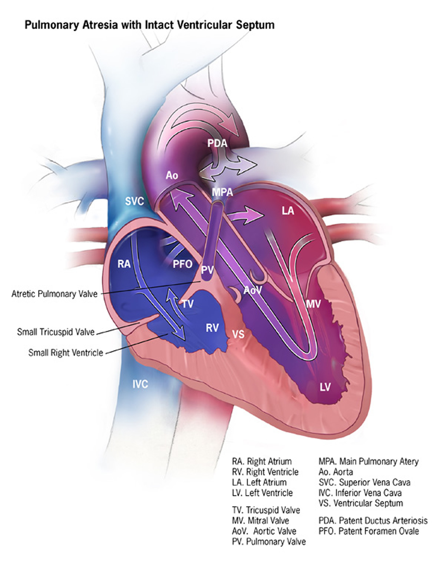 Pulmonary Atresia
