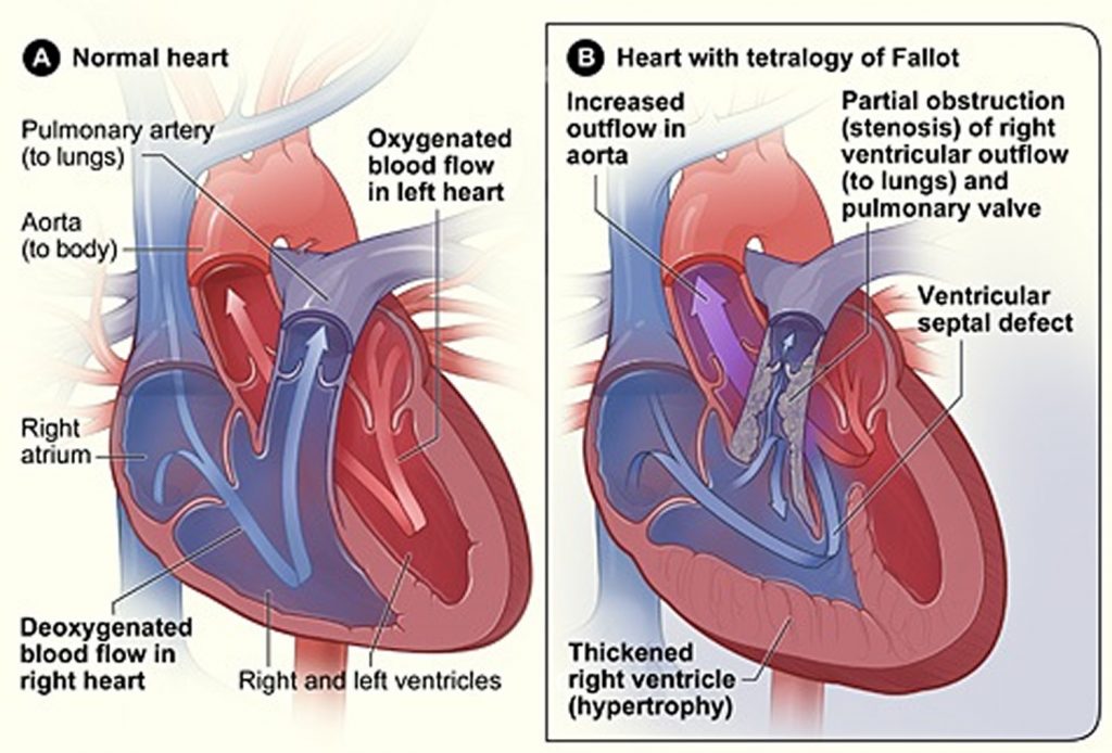 What is Congenital Heart Disease - Types, Causes, and Symptoms