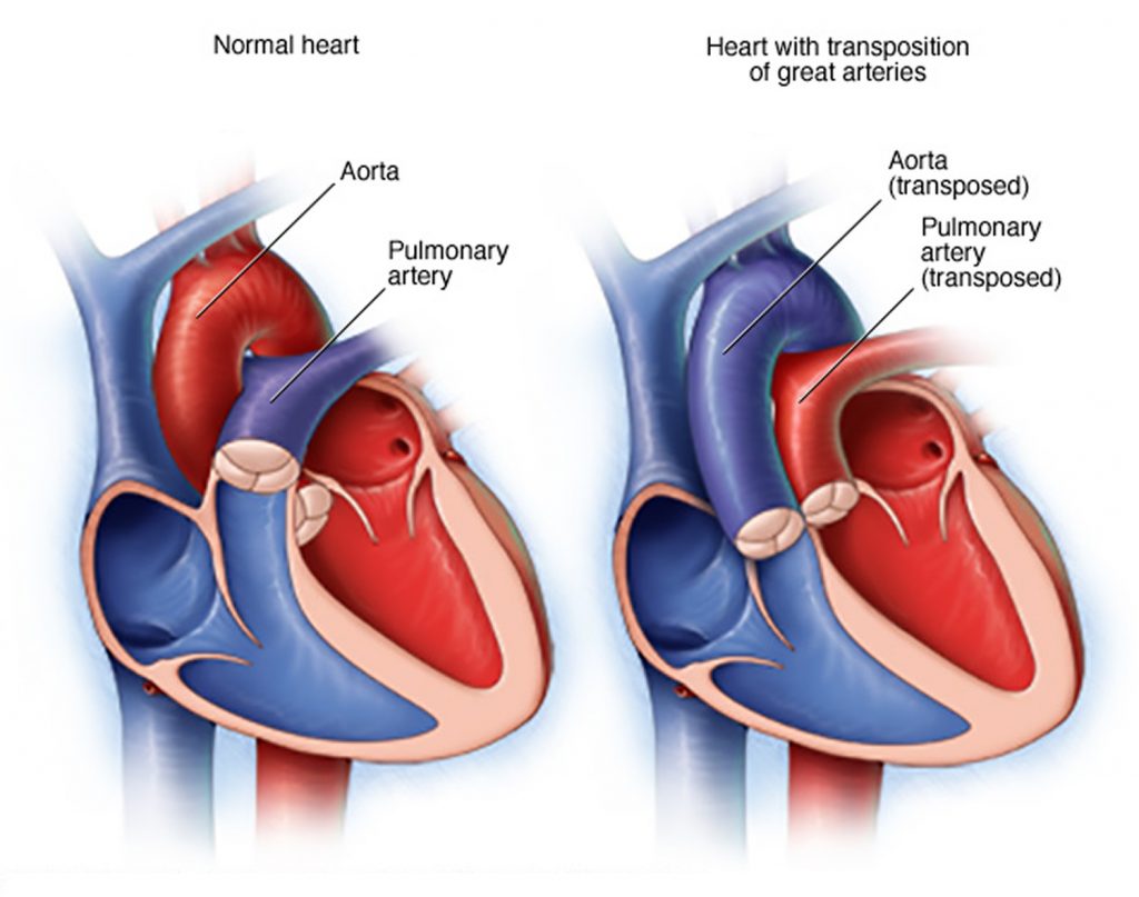 What is Congenital Heart Disease - Types, Causes, and Symptoms