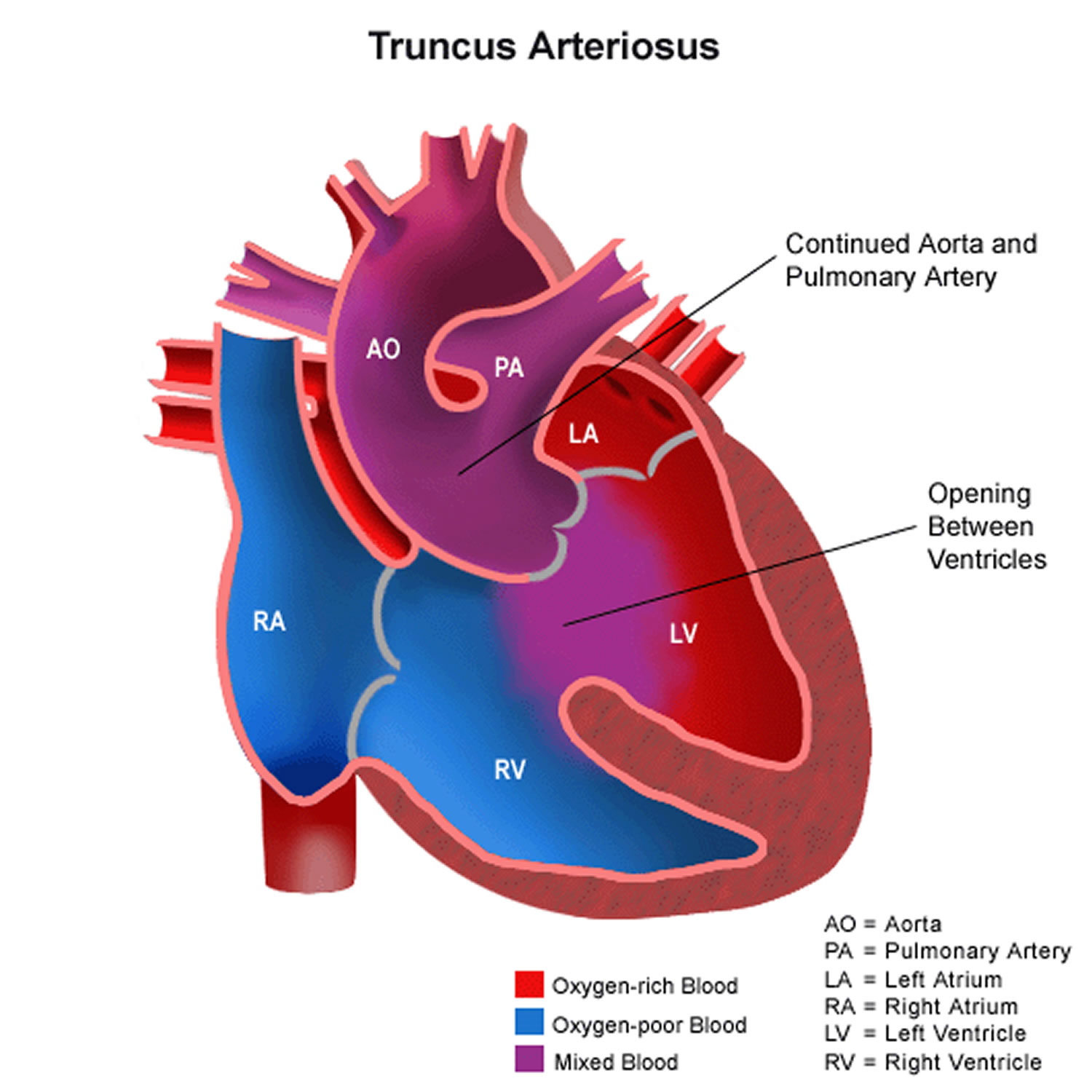 Truncus Arteriosus