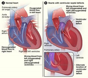 Eisenmenger Syndrome- Causes, Diagnosis, Life Expectancy & Treatment